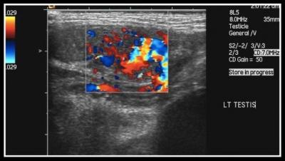 Figure 1: Ultrasound of the left testis which demonstrates an increase in doppler signal within the testis. The left testis is in the inguinal canal.